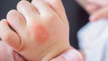 Eczema 101: The Role of Bacteria and Balance in Skin Health