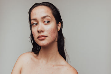 The Link Between Hormonal Acne and Your Skin Microbiome
