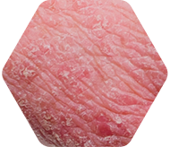 Eczema