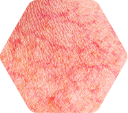 Rosacea